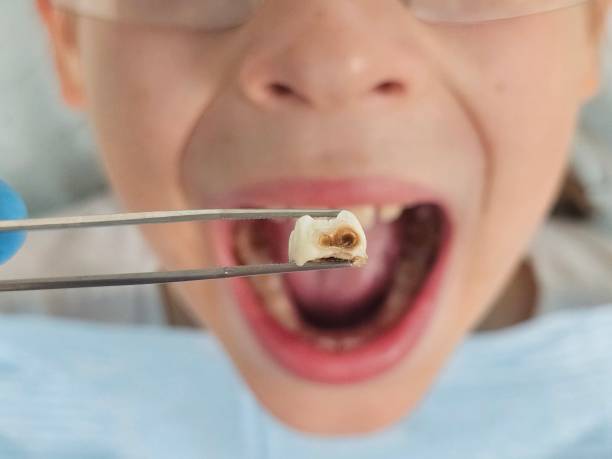 Best Emergency Dentist for Lost Fillings or Crowns in Cetronia, PA